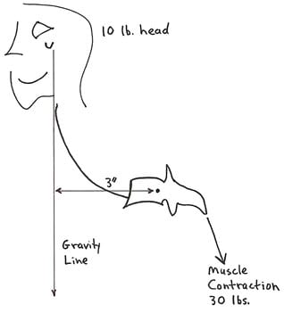  Rene Cailliet, MD, also uses the first class lever example in his 1996 book Soft Tissue Pain and Disability pertaining to the forward head syndrome (17). The patient has an unbalanced forward head posture. Dr. Cailliet assigns the head a weight of 10 lbs. and displaces the head’s center of gravity forward by 3 inches. The required counter balancing muscle contraction on the opposite side of the fulcrum (the vertebrae) would be 30 lbs. (10 lbs. X 3 inches):