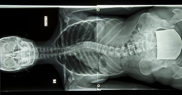 Low Back Pain & Adolescent Idiopathic Scoliosis