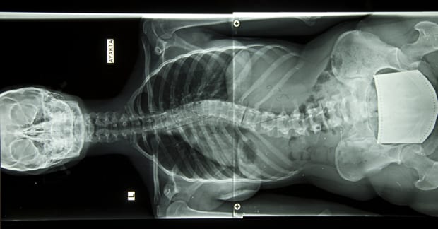 Dolor Lumbar y Escoliosis Idiopática Adolescente