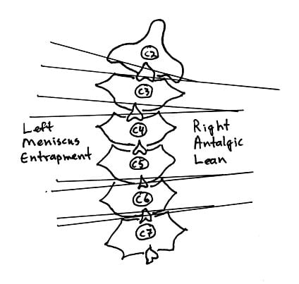 right antalgic lean cervical vertebrae