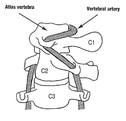 Right cervical spine (head) rotation, showing the tension on the left vertebral artery between the atlas and axis 