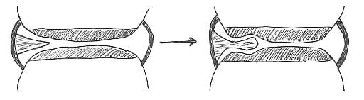 With repeated mechanical impingement between the articular surfaces, the synovial fold may differentiate into fibrous tissue to varying degrees. The fibrous apex of the synovial indents the articular hyaline cartilage, further entrapping the apex of the synovial fold. Manipulative therapy may traction and separate the articular surfaces apart, releasing the entrapped synovial fold. 