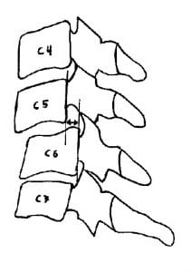 Cervical Spine Injury and Clinical Instability