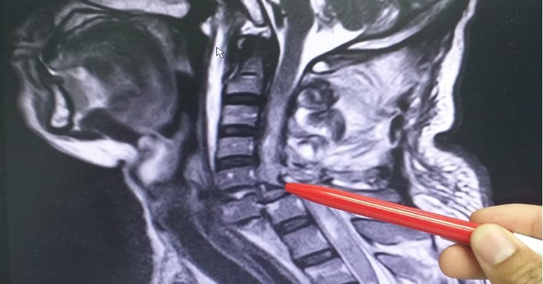 cervical-spine-injury-image-mri-scan-picture-id1129624317