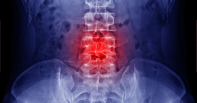 Chiropractic Care and X-Rays for Low Back Pain
