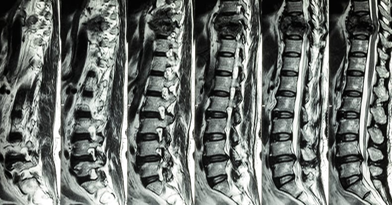 Truths & Myths of MRI for Low Back Pain