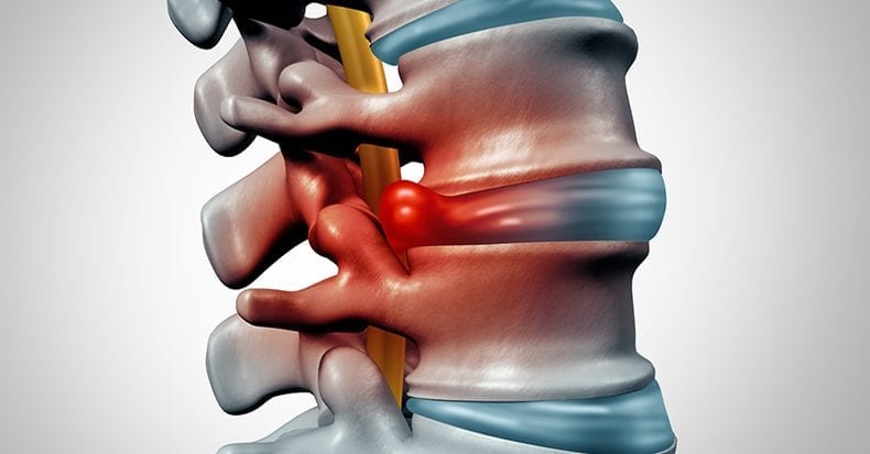 lumbar-spine-herniated-intervertebral-disk-with-discogenic