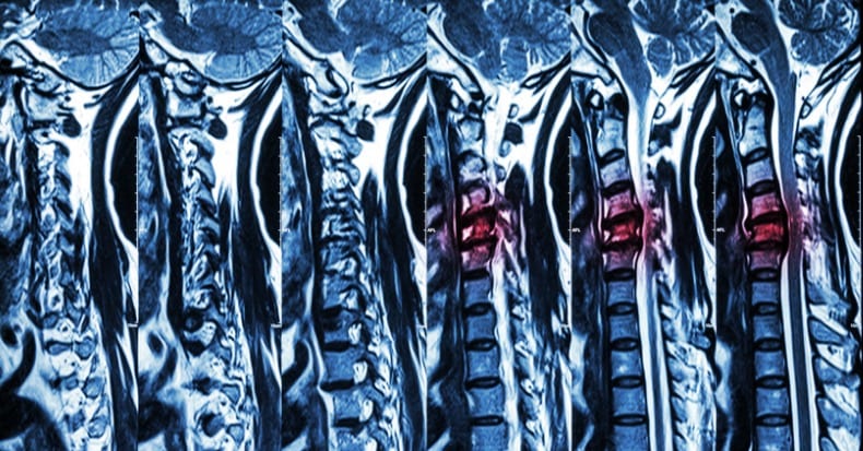 what is spinal spondylosis