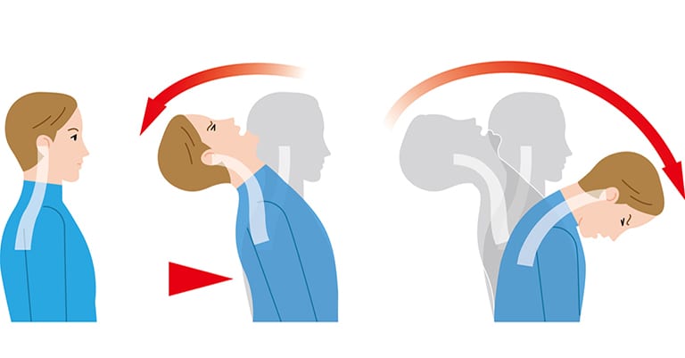 Latigazo Cervical y Dolor en la Espalda Media - ¿Cómo Puede Pasar Esto?