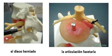 model of vertebrae facet joint and herniated disk