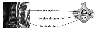 hernia de disco   nervios pinzados médula espinal