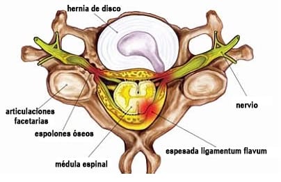 hernia de disco articulaciones facetarias  espolones óseos  médula espinal espesada ligamentum flavum nervio