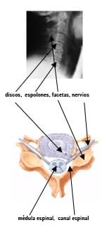 discos,  espolones, facetas, nervios    médula espinal,  canal espinal 