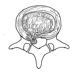 sequestration disk