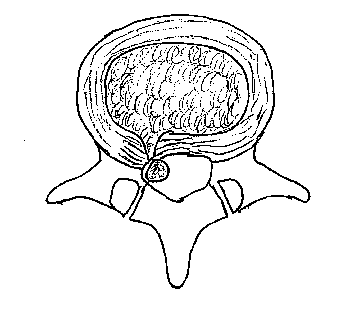 cervical-versus-lumbar-intervertebral-discs