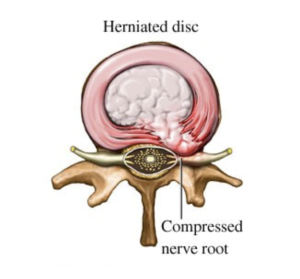 Also, with age, acute injury, or repetitive stress, the fibers of the annulus can degrade, allowing for the types of herniations shown above. When the nucleus moves in a posterior (backwards) direction, it may put pressure on the nerve root, the cauda equina, or the spinal cord 