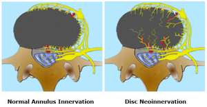    Normal Annulus Innervation		     Disc Neoinnervation