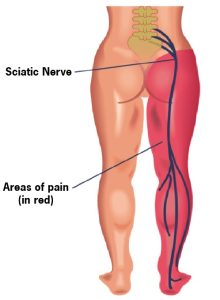 The sciatic nerve is a nerve that begins in the lower back and travels through the buttock and down into the back of the leg and then into the foot. It is the longest and widest nerve in the human body. The sciatic nerve is made up of five lumbosacral nerve roots, L4, L5, S1, S2, and S3.