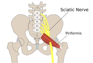 When a peripheral neuropathy exists independent from radicular involvement, the treatment is to the peripheral lesion. In the example of piriformis syndrome sciatica, treatment would be to the piriformis muscle and to the hip joint. Pelvic unleveling could also be involved, requiring chiropractic evaluation and management.