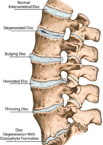 Nerve root irritation