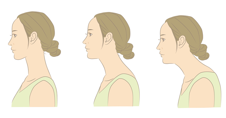 Loss of Cervical Lordosis and Its Connection to Headaches