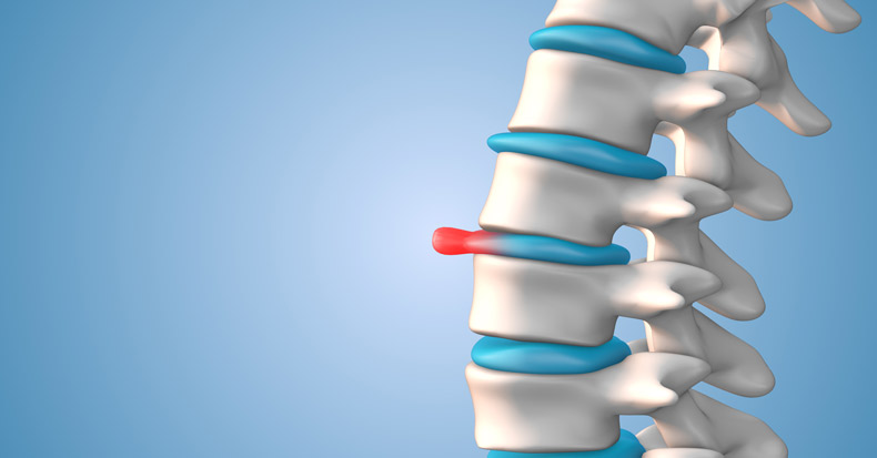 Human spine bulging or herniated disc stock photo