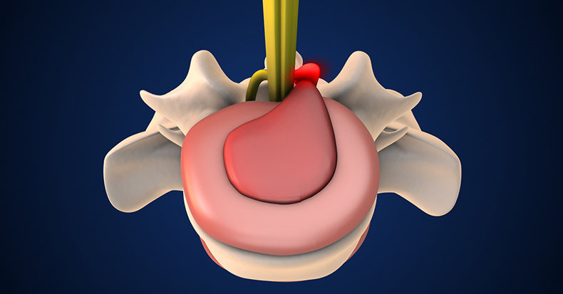 Spinal Manipulation for Lumbar Disk Lesions