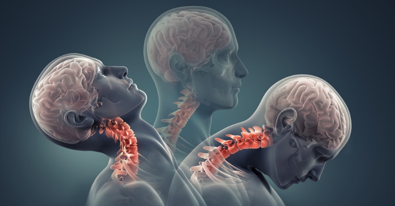 Illustration showing neck movement during whiplash injury with highlighted cervical spine.